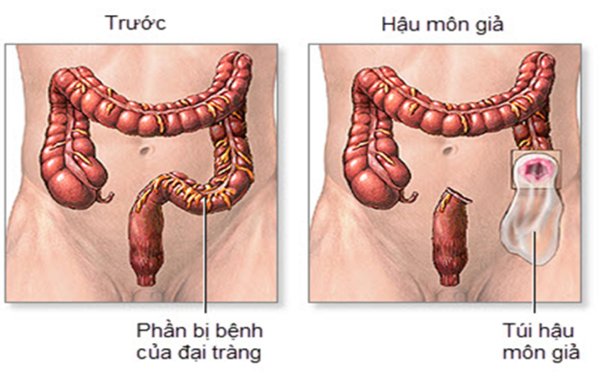 Quy Trình Đóng Hậu Môn Nhân Tạo: Chi Tiết, Các Bước Thực Hiện và Chăm Sóc Sau Phẫu Thuật